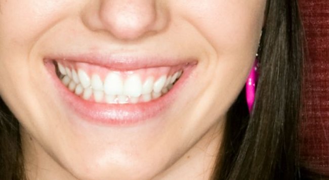 BreezeCare Patients Participate in an Australian Tooth Mousse Study